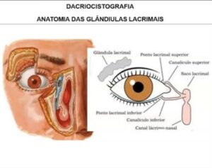 Imagem explicando rapidamente que é Dacriocistografia com imagens de olho.